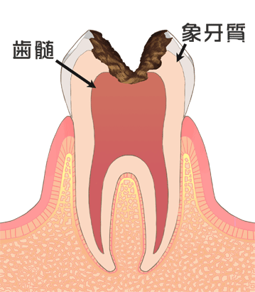 歯の神経にまで侵された虫歯