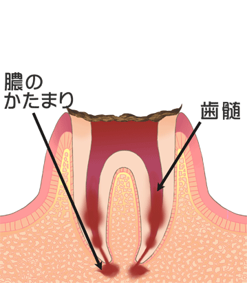 歯冠が崩壊した虫歯